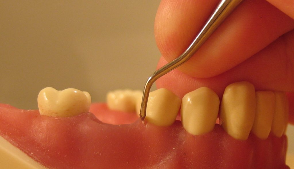 Odstopanje dlesni od zob