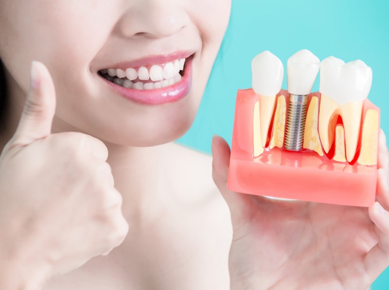 Zobni implantati – nadomestki zob v obliki titanovega vijaka